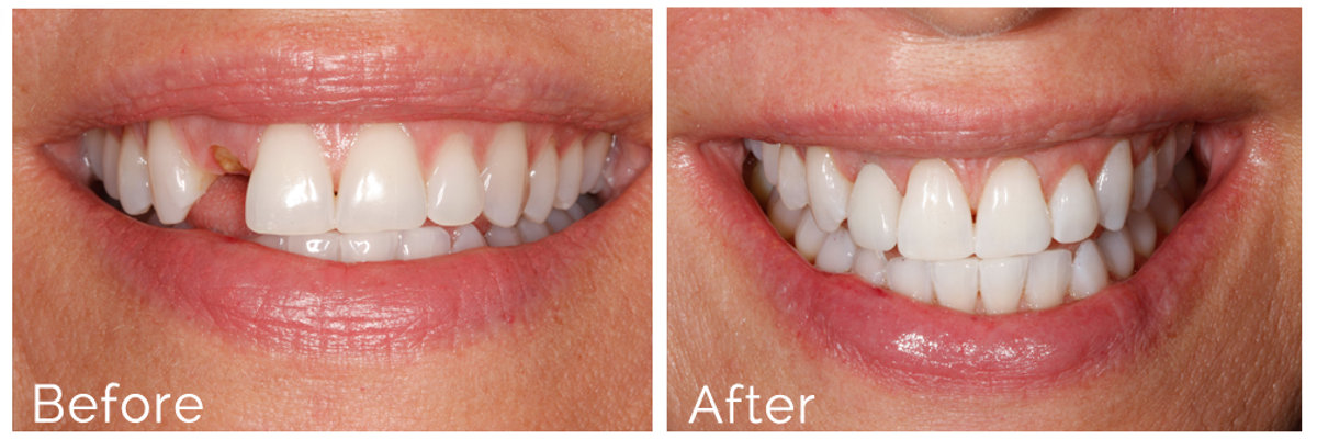 Composite Veneers